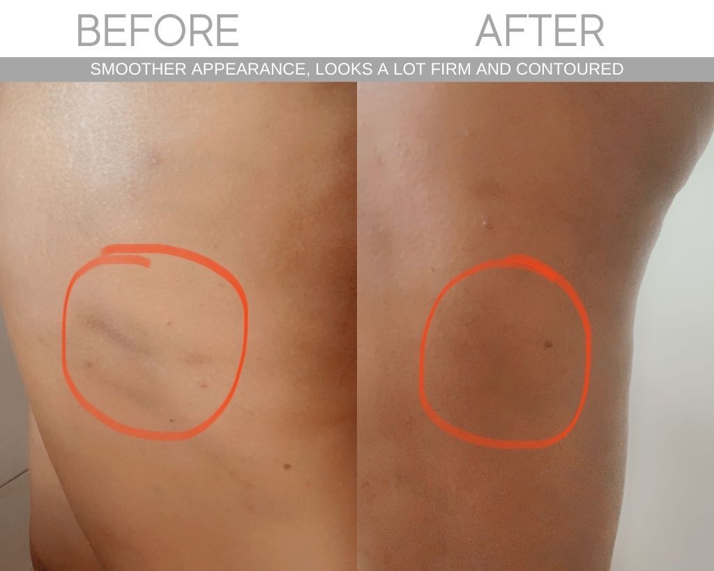 Cellulite Cupping Set - SCULPT